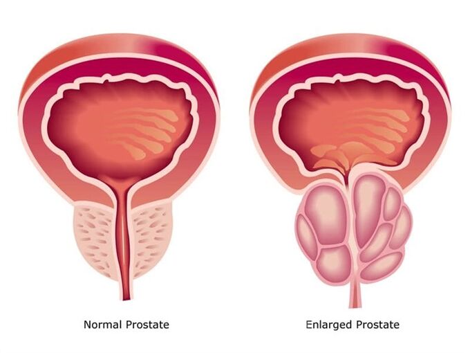 Prostovit, prostatın işini ve boyutunu normalleştirir