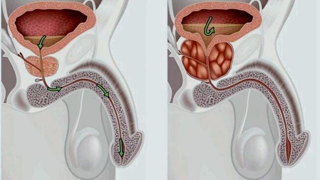prostatit ile sağlıklı ve iltihaplı prostat