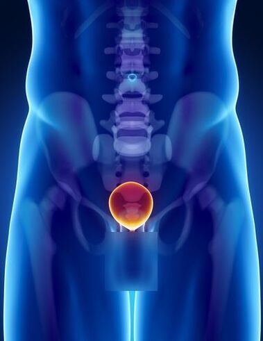 Prostatitli bir erkekte prostat bezinin iltihabı